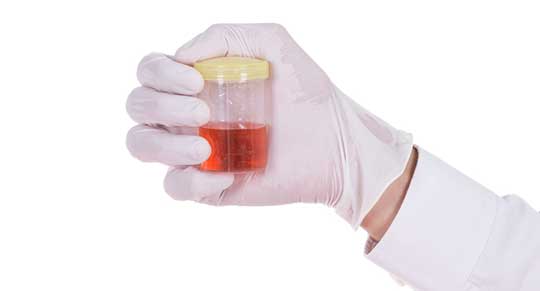 Hematuria-Caused-by-Ureter-Cancer