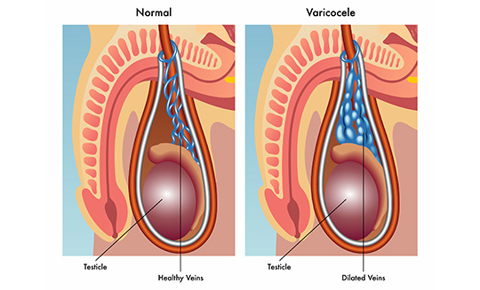 Illustration-of-Varicocele