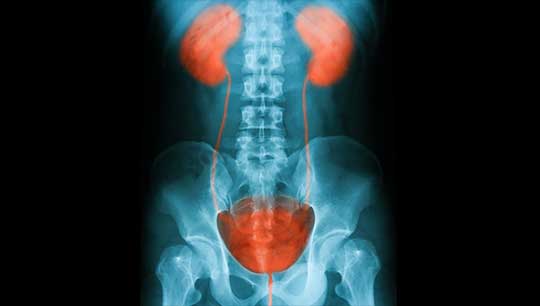 Neurogenic-Bladder-X-Ray