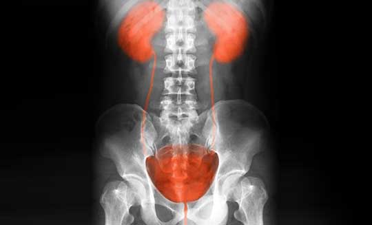 X-Ray-of-Bladder-Prior-to-Radical-Cystectomy