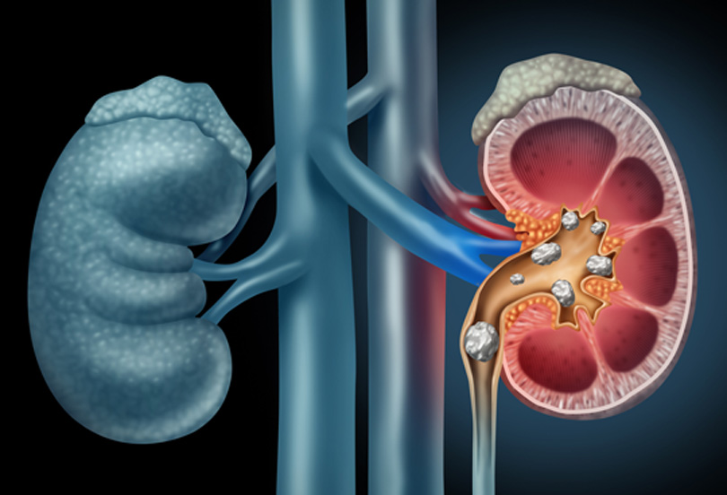 concept-of-kidney-stones-best-urology-clinic-in-Orange-County