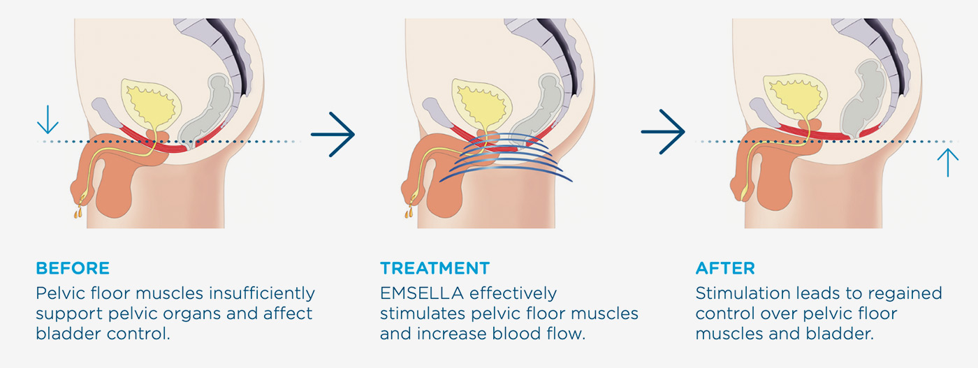 emsella-diagram-men