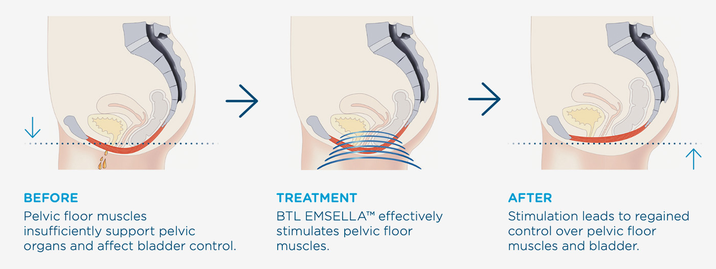 emsella-diagram-women