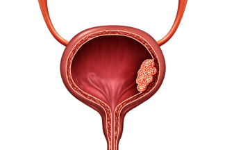 Bladder Cancer Causes