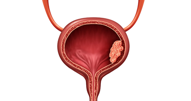 Bladder-Cancer-Causes