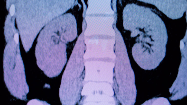 CT-Scans-of-the-bladder