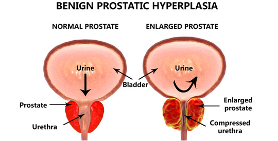 Enlarged-Prostate-Diagram