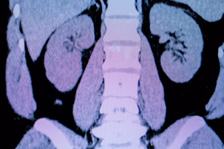 How accurate is CT scan for bladder cancer?