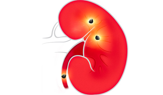 Kidney-Stone-Diagram