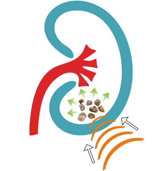 Shock-wave-lithotripsy