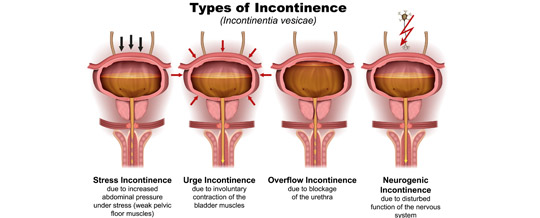 Types-of-Urinary-Incontinence