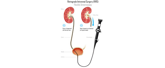 Ureteroscopy