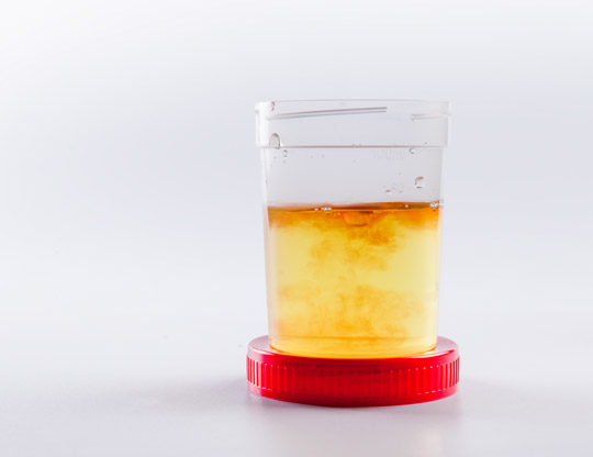 Urine-Sample-for-Kidney-Stone-Testing