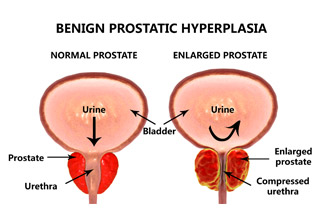 What-is-the-latest-treatment-for-enlarged-prostate