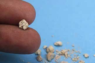 kidney_stones_kidney_disease_kidney_stones