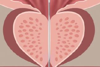 male_urology-Optilume-BPH-Catheter-System