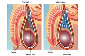 male_urology_microscopic_varicocele_surgery