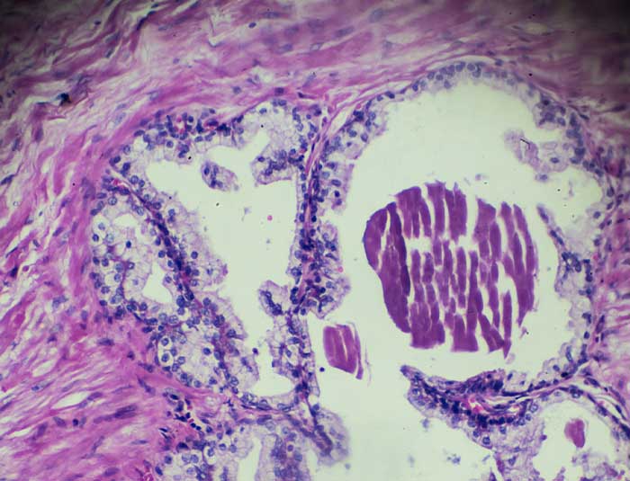 prostate-cells-prostate-biopsy-UCI-Urology