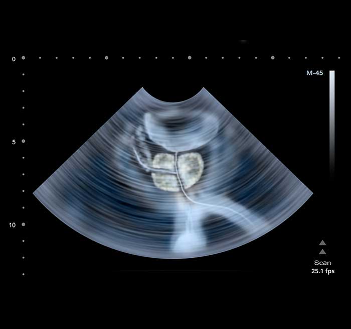 ultrasound-image-used-in-Artemis-biopsy-UCI-Urology