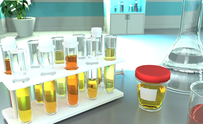 urine-quality-test-for-hematuria-best-urology-hospital-in-Orange-County