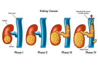 urological_cancers_kidney_cancer